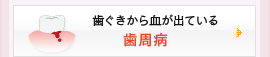 歯ぐきから血が出ている：歯周病