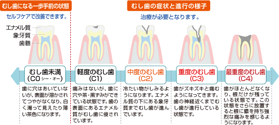 虫歯の進行について