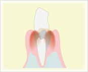 歯周病は歯を失う原因のひとつです
